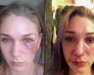 Татьяна Арленинова после причиненных ей побоев